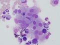 Metastatic carcinoma (CSF)