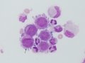 Metastatic carcinoma (CSF)