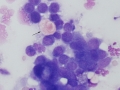 Metastatic carcinoma (brain mass)