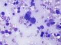 Metastatic carcinoma (brain mass)
