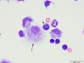 Meningoencephalitis of undetermined etiology (MUE)