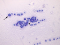 Metastatic carcinoma