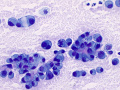 Metastatic carcinoma