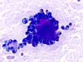 Metastatic carcinoma