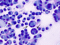 Metastatic carcinoma