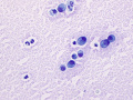 Metastatic carcinoma