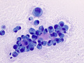 Metastatic carcinoma