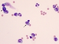 Mixed inflammation