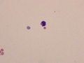 Reactive lymphocyte