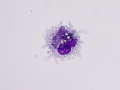 Hemosiderophage