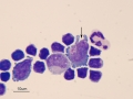 Lymphoma of granular lymphocytes