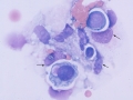 Extramedullary plasmacytoma