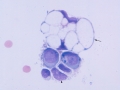 Extramedullary plasmacytoma