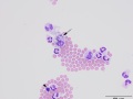 Steroid responsive meningitis-arteritis (SRMA)