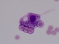 Storage disease