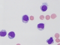 Lymphocytic pleocytosis