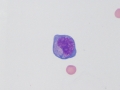 Lymphocytic pleocytosis
