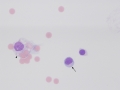 Lymphocytic pleocytosis