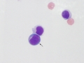 Lymphocytic pleocytosis