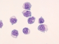 Lymphoma