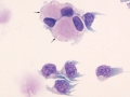 Lymphoma