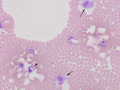 Fibrocartilagenous embolism (FCE)