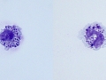 Storage disease