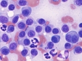 Extramedullary plasmacytoma