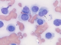 Histiocytoma