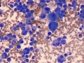 Histiocytic sarcoma (DQ)