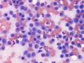 Extramedullary plasmacytoma