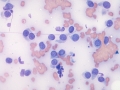 Histiocytoma