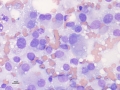 Histiocytic sarcoma (dog)