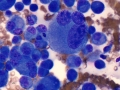Histiocytic sarcoma (DQ)