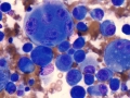 Histiocytic sarcoma (DQ)