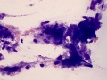 Extramedullary plasma cell tumor & amyloid