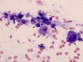 Extramedullary plasma cell tumor & amyloid