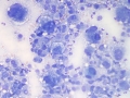 Histiocytic sarcoma (presumptive, cat)
