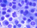 Extramedullary plasmacytoma (DQ)