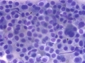 Extramedullary plasmacytoma (DQ)