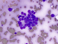 Plasma cell tumor