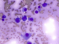 Plasma cell tumor