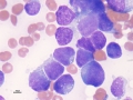 Nephroblastoma (suspect)