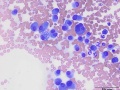 Russell body-rich plasmacytoma