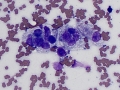 Lymphoma (bladder)