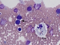 Lymphoma (bladder)