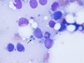 Lymphoma