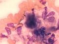 Plasmacytoma with amyloid