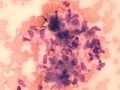 Plasmacytoma with amyloid