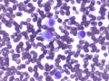 Histiocytoma (DQ)